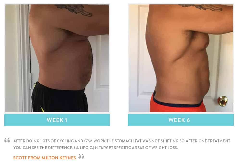 Before & After Stomach Fat Hounslow Heath