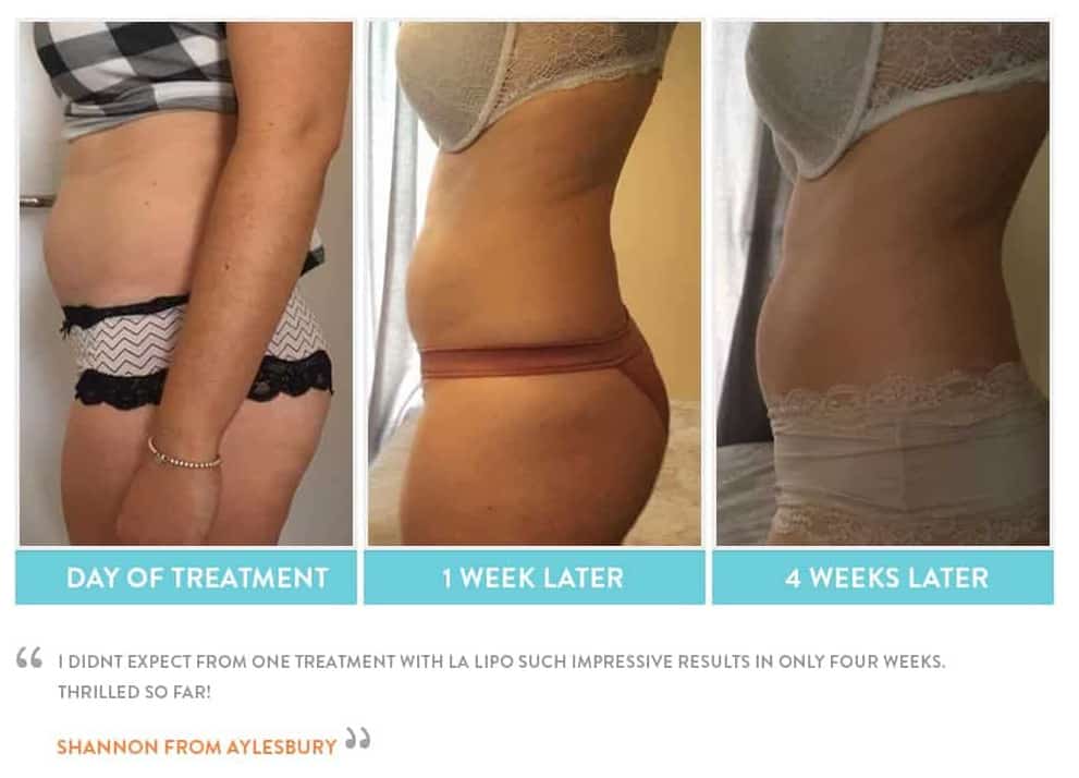 before, Cryolipolysis Hounslow Heath
