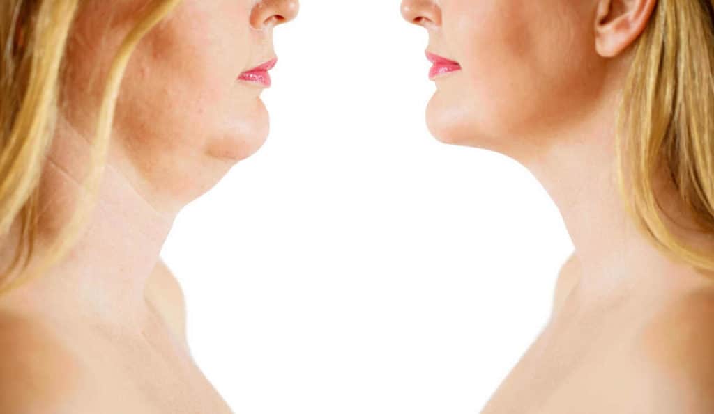 Double Chin treatment Hounslow Heath before and after results