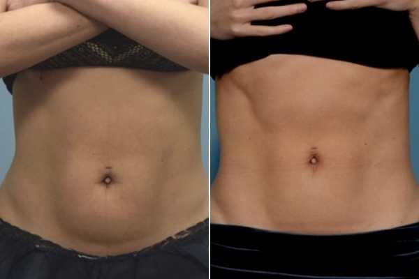 body sculpting FAQs Hounslow Heath
