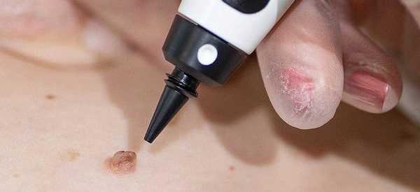After Skin Tag Removal Hounslow Heath