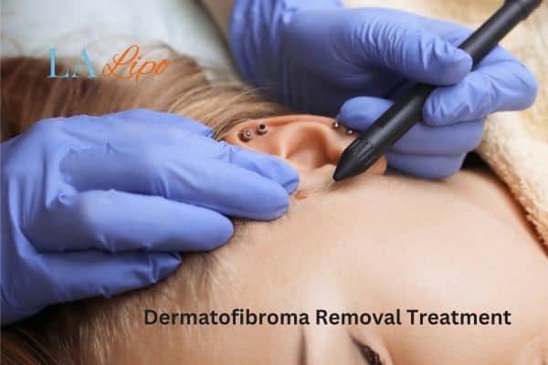 Dermatofibroma Removal Treatment Hounslow Heath