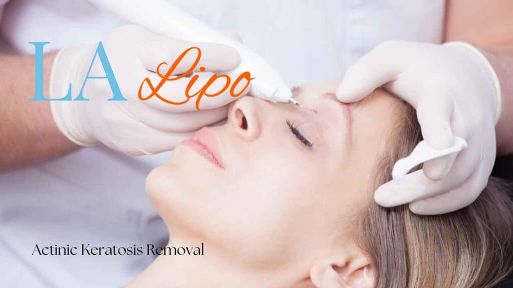 actinic keratosis removal Hounslow Heath