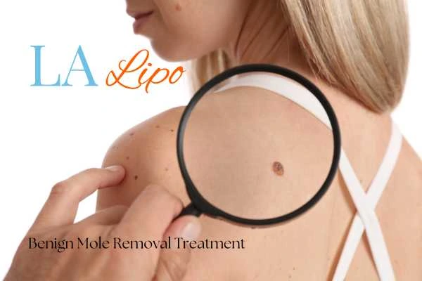 Woman having her inspection of blemish before mole removal Hounslow Heath