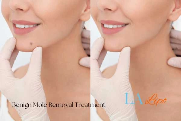 woman's before and after mole removal Hounslow Heath results