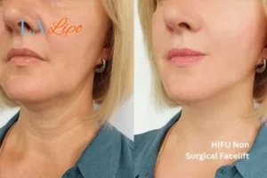 hi-fu for wrinkles Hounslow Heath before and after results