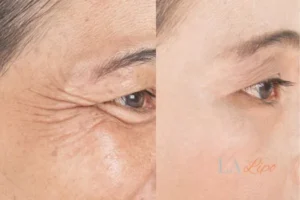 Before and after results of woman - HI-fu wrinkles reduction treatment Hounslow Heath