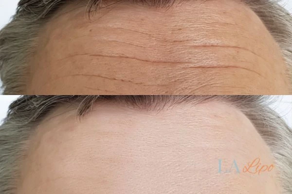results of HIFU Hounslow Heath on mans forehead to help reduce lines and wrinkles
