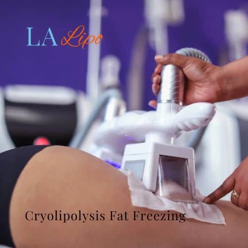 fat freezing - Cryolipolysis Hounslow Heath