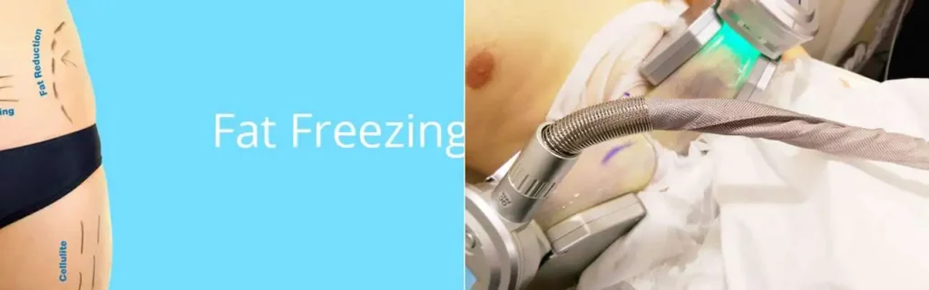 multi areas of a persons body having coolsculpting Hounslow Heath treatment