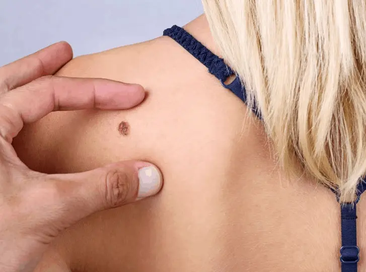 woman having mole removal Hounslow Heath consultation before treatment.
