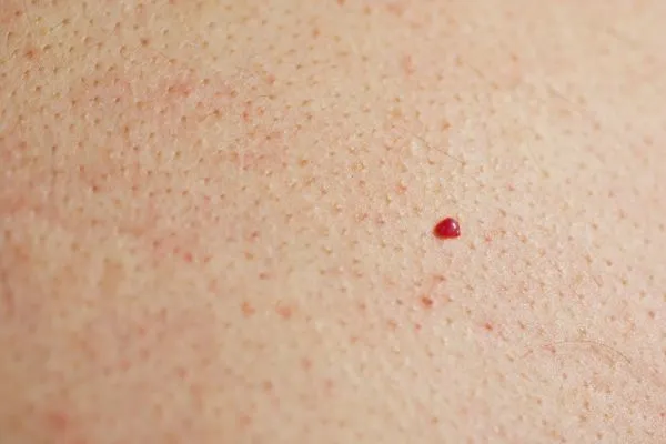 close up of a cherry angioma Hounslow Heath