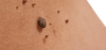 image of a skin tag Hounslow Heath