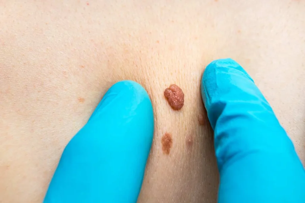 Consultant examining a skin tag Hounslow Heath