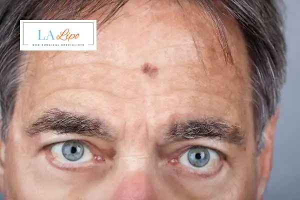 Solar Lentigo Removal Hounslow Heath image of man with mark on his forehead
