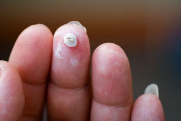 wart on person finger - cryotherapy to treat from LA LIPO Hounslow Heath