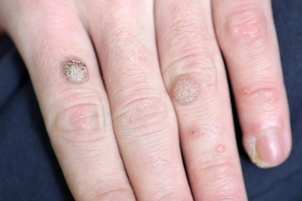 photo of warts on person hand - see wart removal Hounslow Heath from LA LIPO