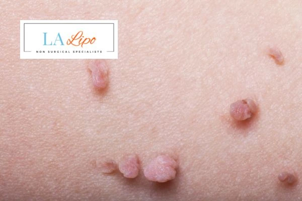 Does cryopen skin tag removal Hounslow Heath hurt? Find out now call our team today!