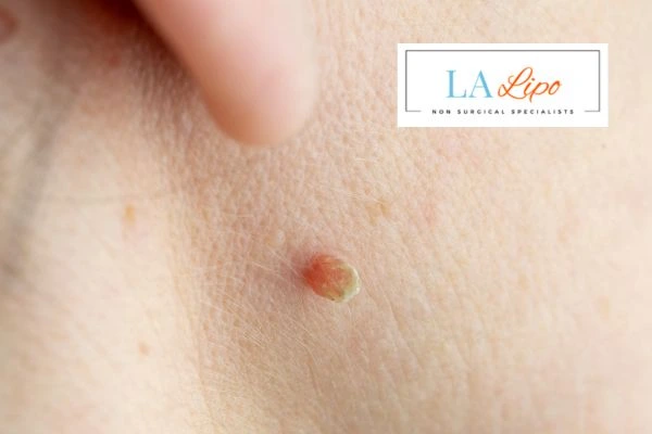 Book skin tag removal Hounslow Heath today speak to our team now!