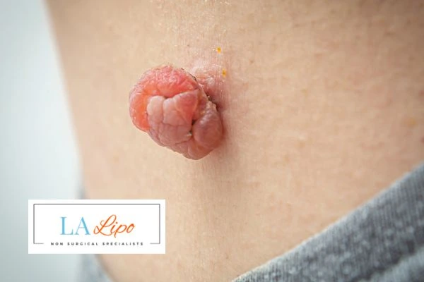 Interested in skin tag removal Hounslow Heath? Concerned about the pain? Find out more today!