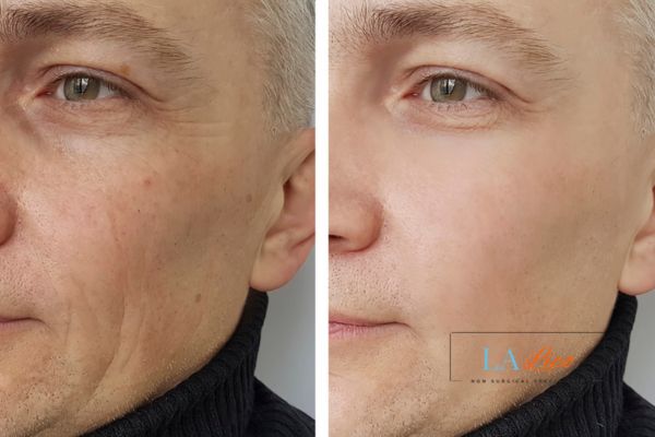 See the amazing results of Morpheus8 Treatment Hounslow Heath!