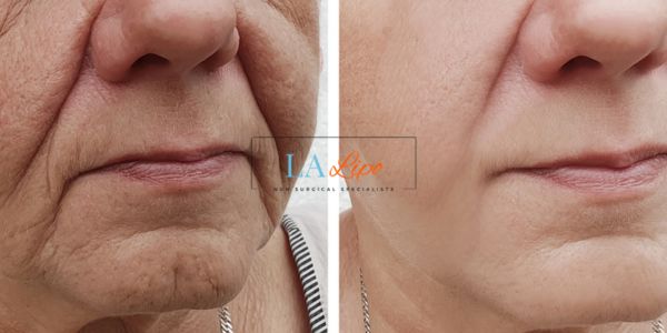 Older lady deeper wrinkle reduction - LA LIPO Morpheus 8 Results Hounslow Heath