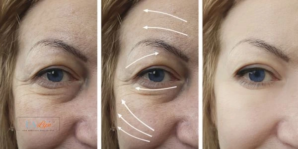 Amazing eye lift Morpheus 8 results Hounslow Heath