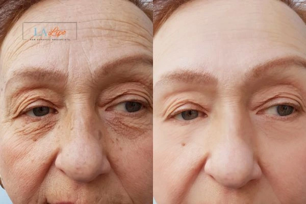 The powerful benefits of Morpheus8 Treatment Hounslow Heath - Call Our team today!