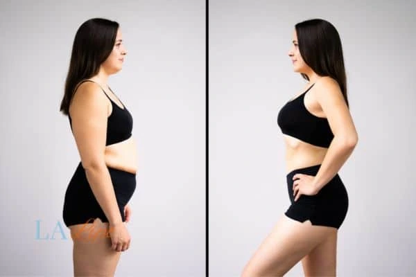 Picture of womans before and after using LA-EMS body sculpting to improve her core strength Hounslow Heath