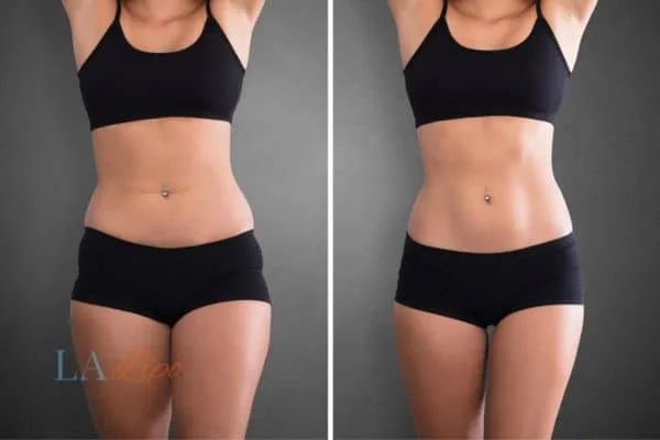 before and after results of non-surgical treatment to help a woman's body image and mental health Hounslow Heath