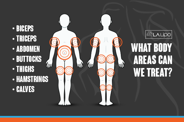 Diagram to show areas you can have LA-EMS Body Sculpting Treatment Hounslow Heath