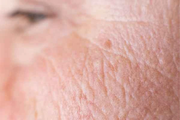 close up picture of a woman's face showing an age spot Hounslow Heath