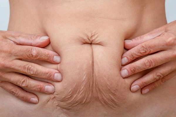 Image of a woman's stomach with loose skin - example of skin tightening Hounslow Heath options